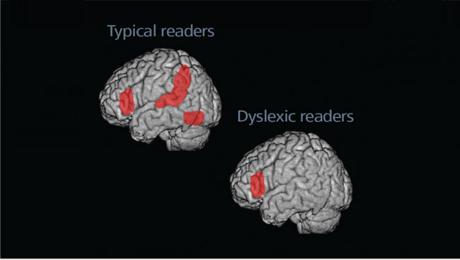 Dyslexia Today