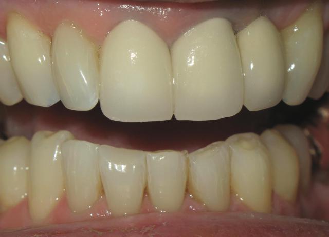 24_Right Occlusal