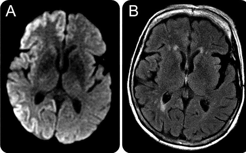 scary-diseases-prion-brain