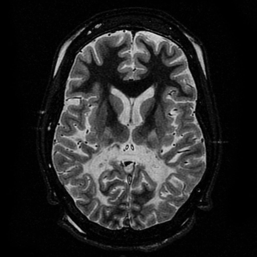  Adrenoleukodystrophy 